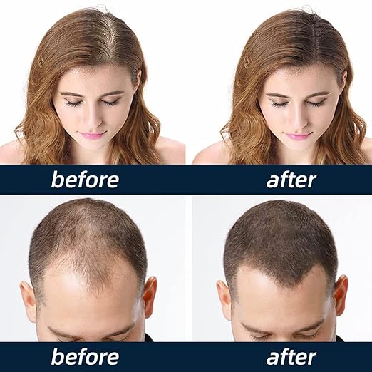 Scalp Care Hair Growth Spray - Anti-Shedding & Hair Regrowth Treatment for Men & Women