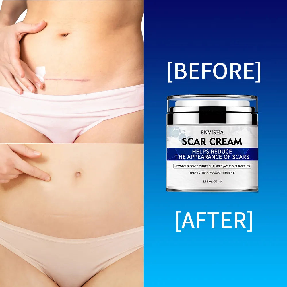 Scar Removal Cream - Advanced Scar Treatment Cream for Surgical Scars, Acne Scars, C-Section, Burns, Stretch Marks - for Old and New Scars